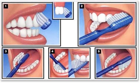 Como escovar os dentes da forma correta e não ter cáries Dr