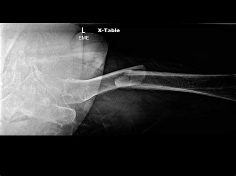 Case Study Subtrochanteric Fracture Following A Fall Clinical Pain