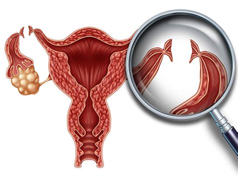 Tubal Ligation - Procedure, Risks and Reversal - Keep Vitality