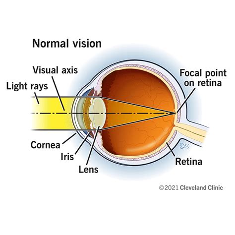 LASIK Eye Surgery