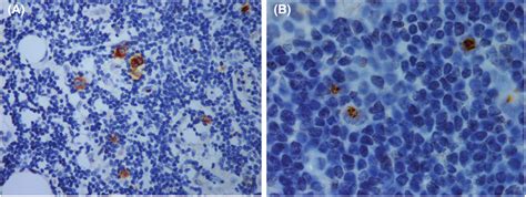 Immunohistochemical Study S Results A Reed Sternberg Cells Showing