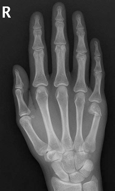 Boxers Fracture Buyxraysonline