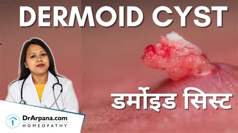 Dermoid Cyst डर्मोइड सिस्ट एक प्रकार की गांठ है जो शरीर के विभिन्न