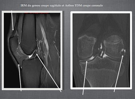 Diagramme De Membre Inf Rieur Diapo Irm Du Genou Coupe