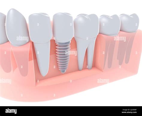 D Ilustraci N De Un Implante Dental Insertado En Una Enc A Junto Con