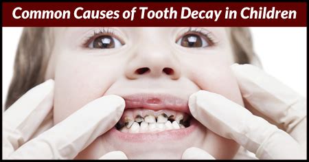 Common Causes of Tooth Decay in Children