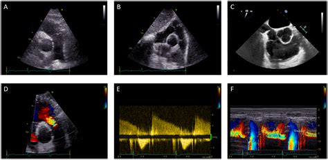 Multimodality Imaging of the Neglected Valve: Role of Echocardiography