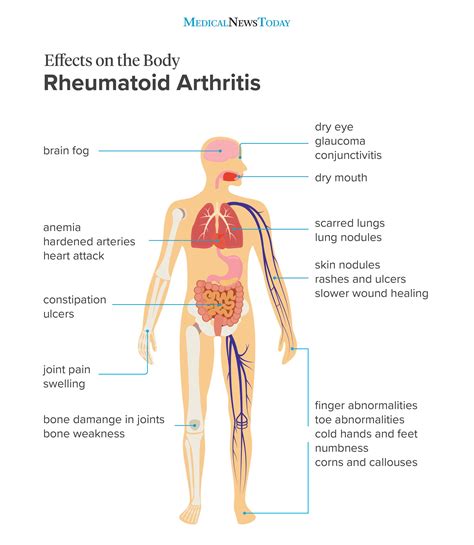 Rheumatoid Arthritis Diagram What Is Rheumatoid Arthritis?
