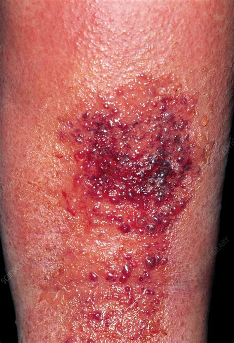 Cellulitis On A Womans Leg After An Insect Bite Stock Image M1300467 Science Photo Library