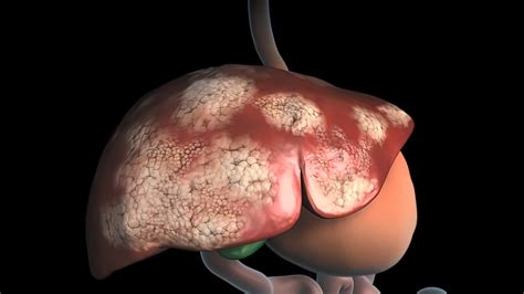 New Combination Of Anti Cxcr4 And Anti Pd1 Therapy Shows Promise For Liver Cancer Treatment