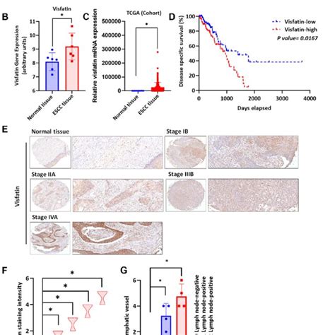 Clinicopathologic Features Of Visfatin Expression In Human ESCC Tissue