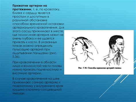 Временная остановка кровотечения наложением давящей повязки, жгута ...