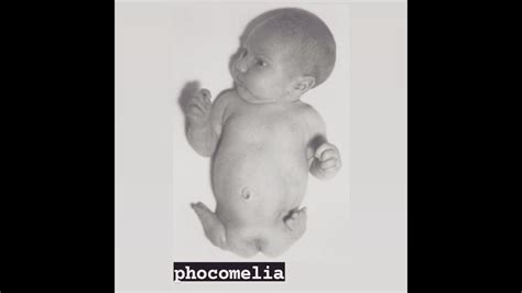 Phocomelia A Limb Abnormality And A Type Of Meromelia Youtube