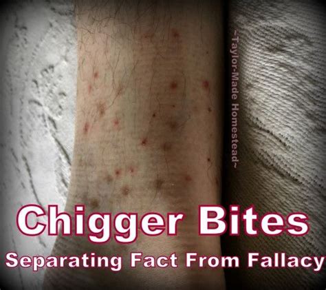 5 home remedies for chigger bites – Artofit