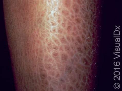 Scaly Skin Ichthyosis Vulgaris Condition Treatments And Pictures For