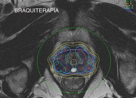 Prostate cancer Centro Gil Vernet de Urología