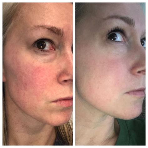 Laser Treatment For Rosacea Near Me