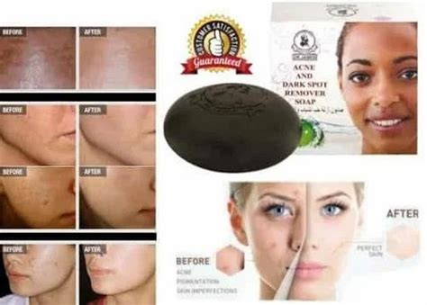 Dr James Acne And Dark Spot Remover Soap At Rs 499 Jaynagar Bengaluru Id 20307537762