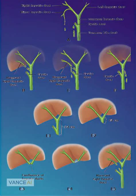 Bile Duct Injuries During Gallbladder Surgery