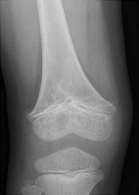 Resection Of A Physeal Bar With Complete Transverse Osteotomy At The