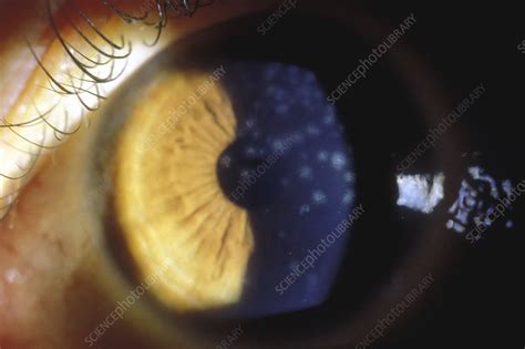 Adenovirus Keratitis