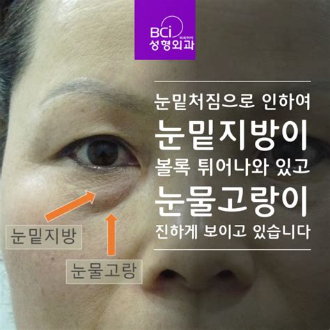 눈밑지방재배치 Vs 단순 눈밑지방제거 수술결과 비교 눈매교정 눈성형의 모든것 비씨아이 성형외과