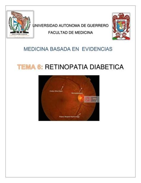 Resúmenes de Retinopatía diabética Descarga apuntes de Retinopatía