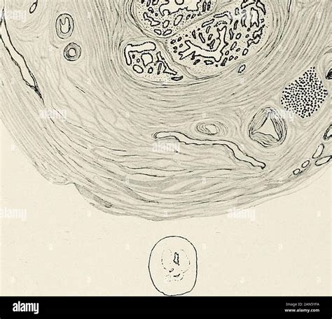 Salpingitis isthmica nodosa hi-res stock photography and images - Alamy