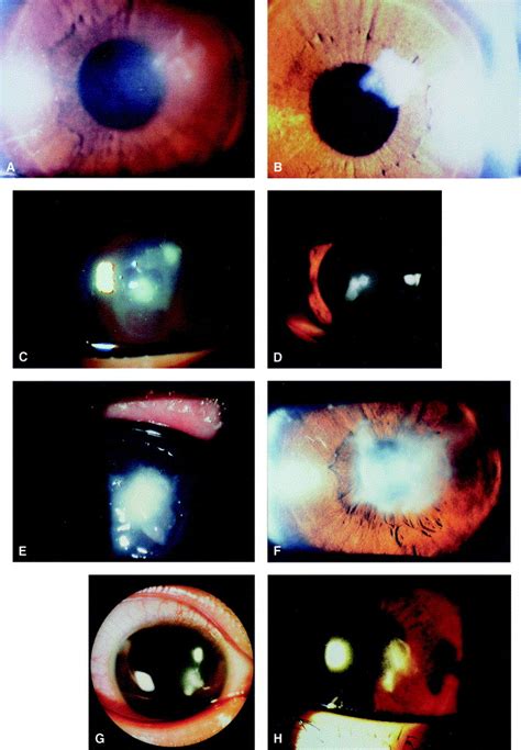 Orthokeratology Lensrelated Corneal Ulcers In Children Ophthalmology