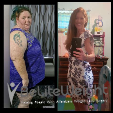 Rose Marie N Mini Gastric Bypass Before And After Beliteweight Weight Loss Services