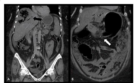 Coronal Abdominal Computed Tomography Scan With The Injection Of