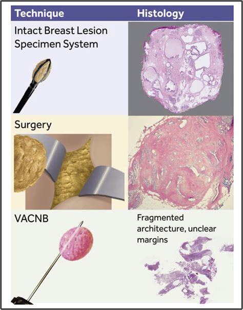 Evaluation Of Percutaneous Vacuum Assisted Intact Specimen Breast