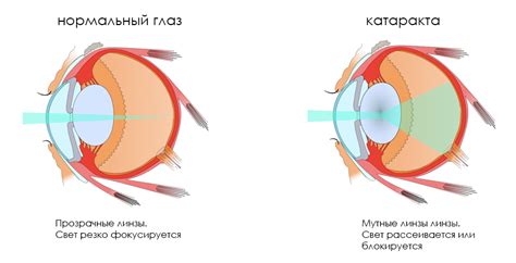 Топ-10 капель от катаракты на 2024 год: выбор, профилактика, признаки