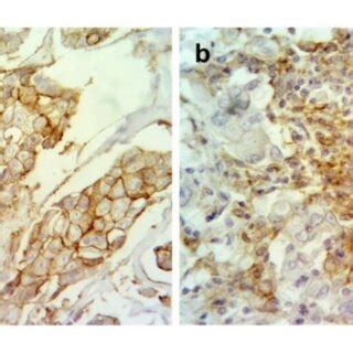 Immunohistochemical staining of CD45RO; membranous expression of CD45RO ...