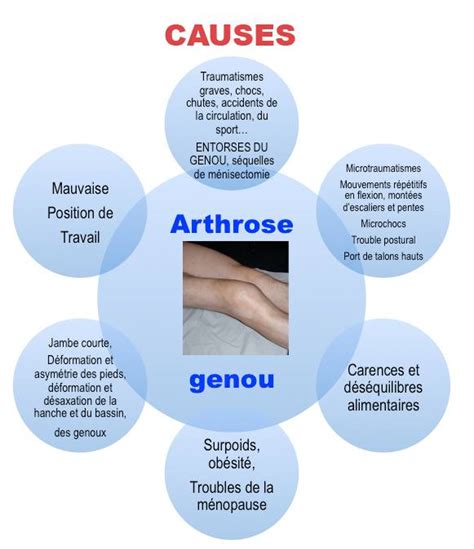 Arthrose Du Genou Et Ost Opathie