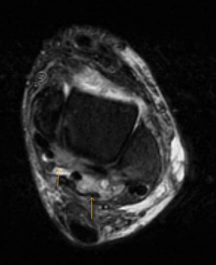 Chronic Tophaceous Gout-MRI - Sumer's Radiology Blog