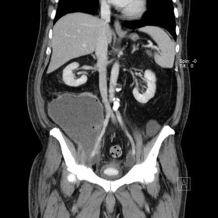 Infected lymphocele after radical prostatectomy | Image | Radiopaedia.org