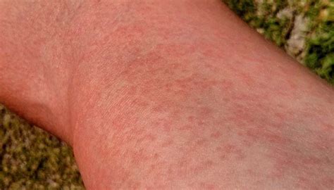 Maculopapular Rash Hiv