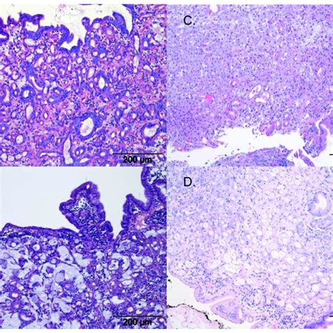 Histopathology Of Gastric Carcinoma According To Who With H E