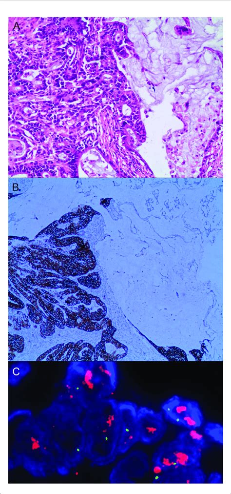 Gastric Mixed Adenocarcinoma A Mixed Mucinous Download