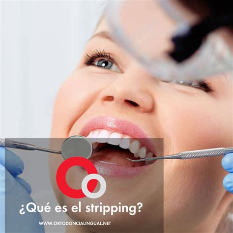 Stripping Dental En Ortodoncia Qu Es Y Para Qu Sirve Cl Nicas