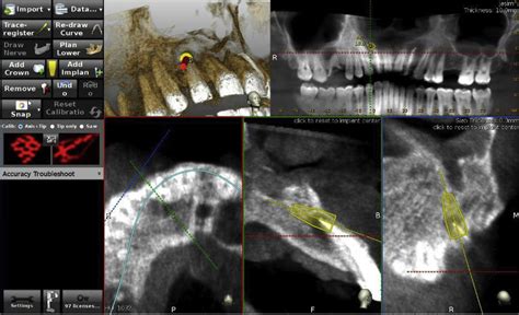 Endodontic Microsurgery Using Dynamic Navigation System A Case Report Journal Of Endodontics