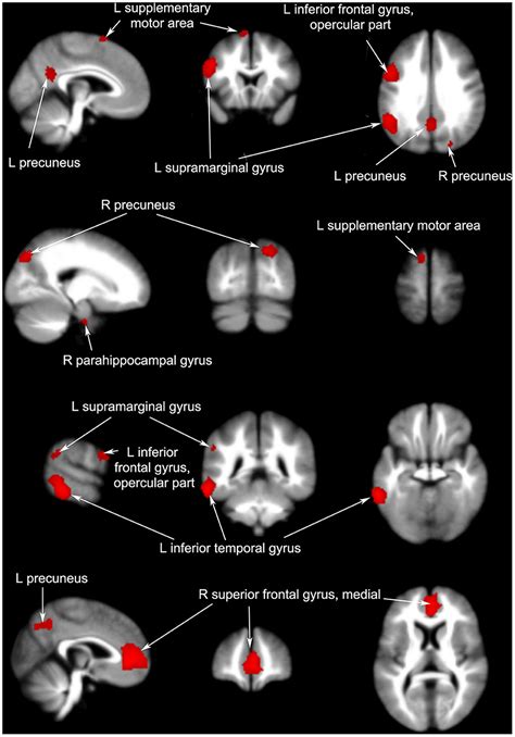 Frontiers Effects Of Acupuncture On The Brain In Primary Insomnia A