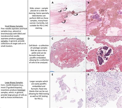 Acquiring Tissue For Advanced Lung Cancer Diagnosis And Comprehensive Biomarker Testing A