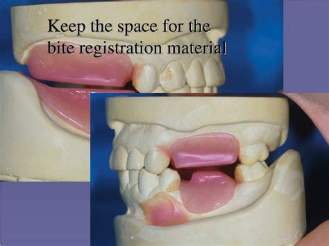 Ppt Removable Partial Denture Rt 453s 2004 Powerpoint Presentation