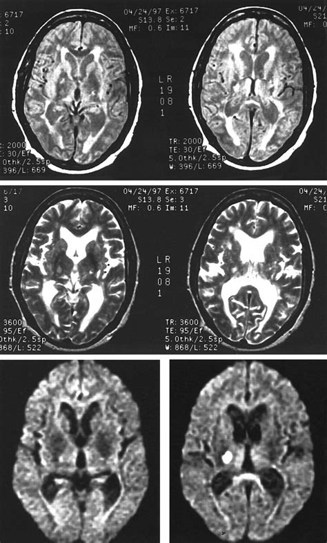 Diffusion Weighted MRI In Acute Subcortical Infarction Stroke