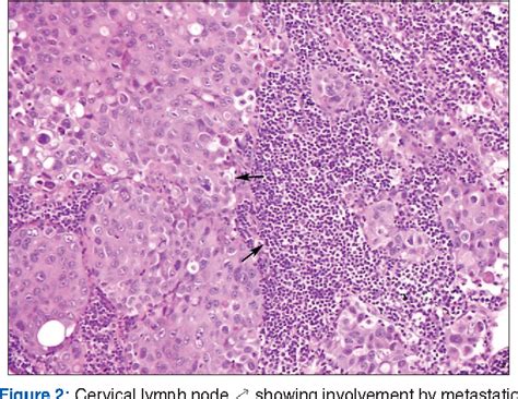 Nasopharyngeal Carcinoma Histology