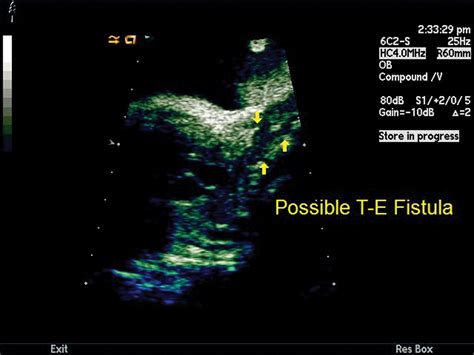 Tracheoesophageal Fistula Ultrasound