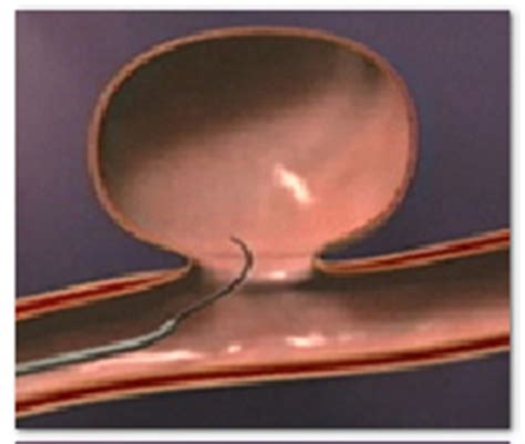 Endovascular Coiling India,Endovascular Coiling Neurosurgery Delhi