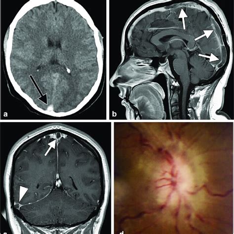 Procedural Data And Outcomes For Patients With Cerebral Venous Sinus